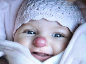 İngiliz bebek Connie ameliyattan önce palyaço burnuyla