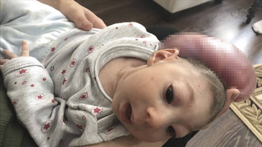 Kafasında kitleyle doğan bebeğin ameliyatını bekliyorlar 1 bebek ameliyat