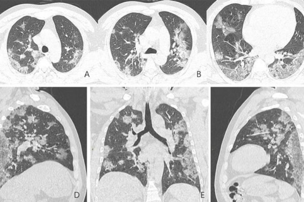 Koronavirüs akciğerleri böyle yok ediyor! 1 koronavirus akciger