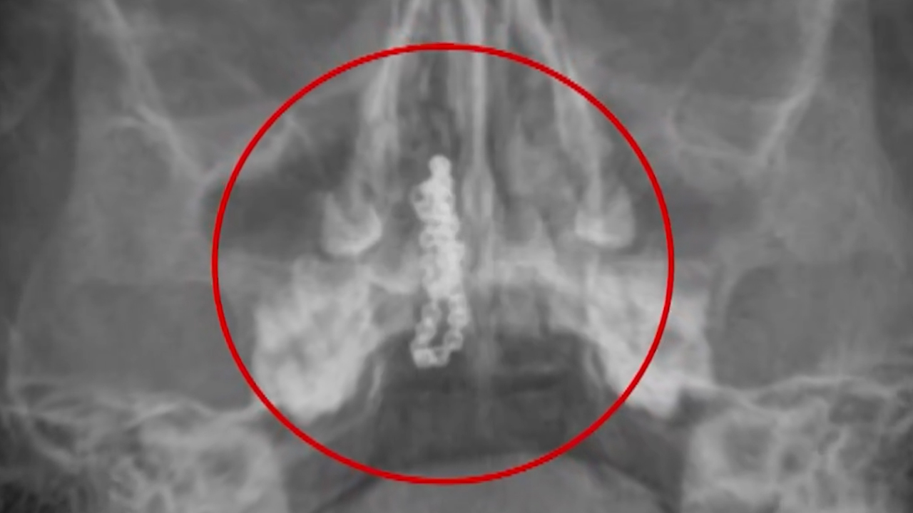 Rize’de çocuğun burnundan tırnak makası zinciri çıktı 1 zincir