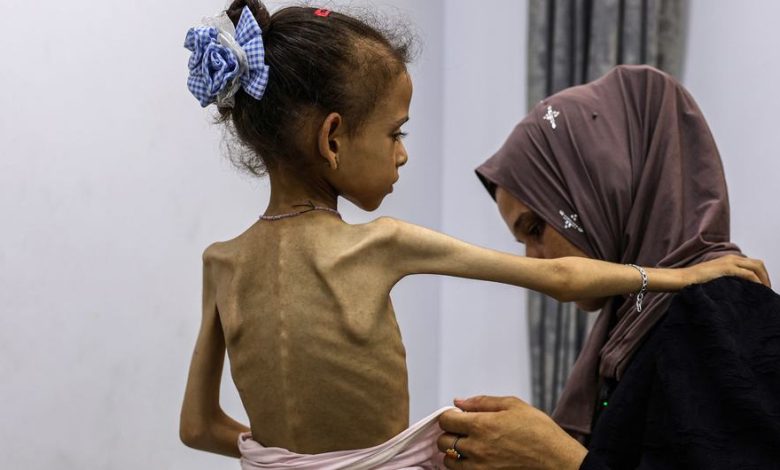 Gazze’de kıtlık resmen ilan edildi. Hastanelerde açlıktan kemikleri sayılan çocuklar doktorların çaresiz mücadelesiyle hayatta kalmaya çalışıyor.