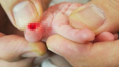 Hatay Eğitim Araştırma Hastanesi’nde tedavi gören 5 aylık Hicran Akay’ın sağ başparmağının, serum sargısı çıkarılırken kesildiği iddia edildi.
